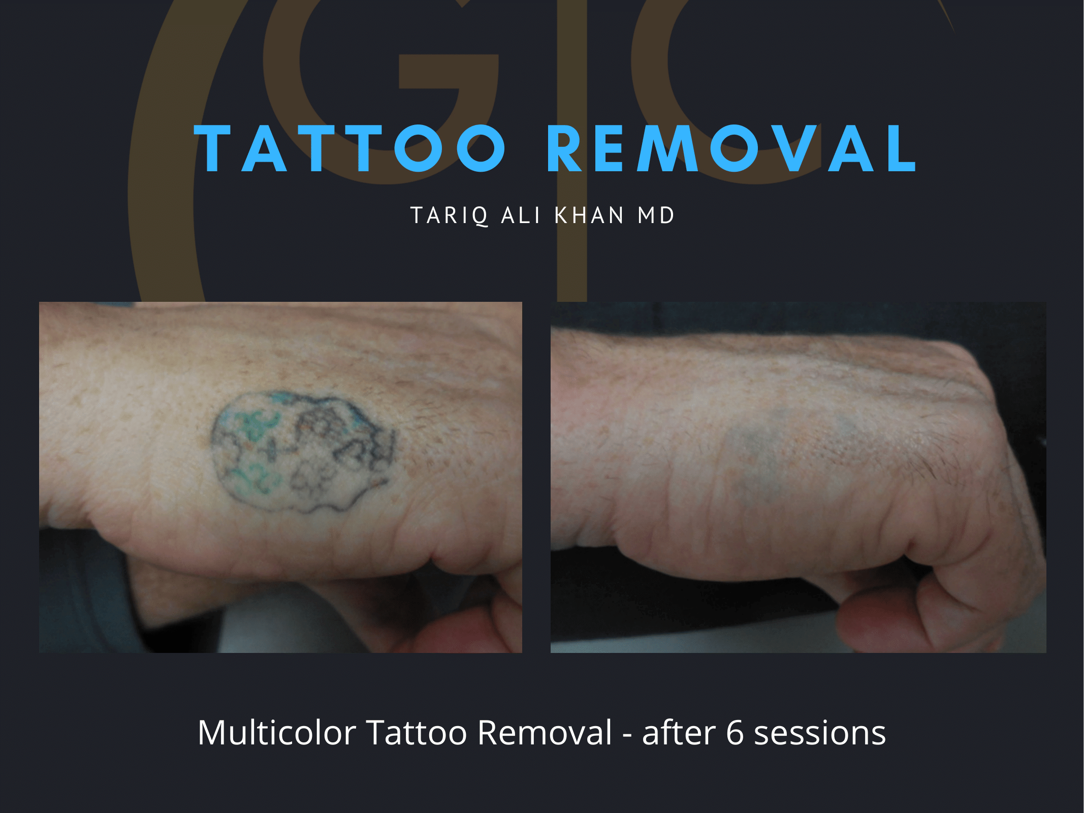 Gentle Care Laser Tustin & Long Beach Before and After picture - Tattoo Removal